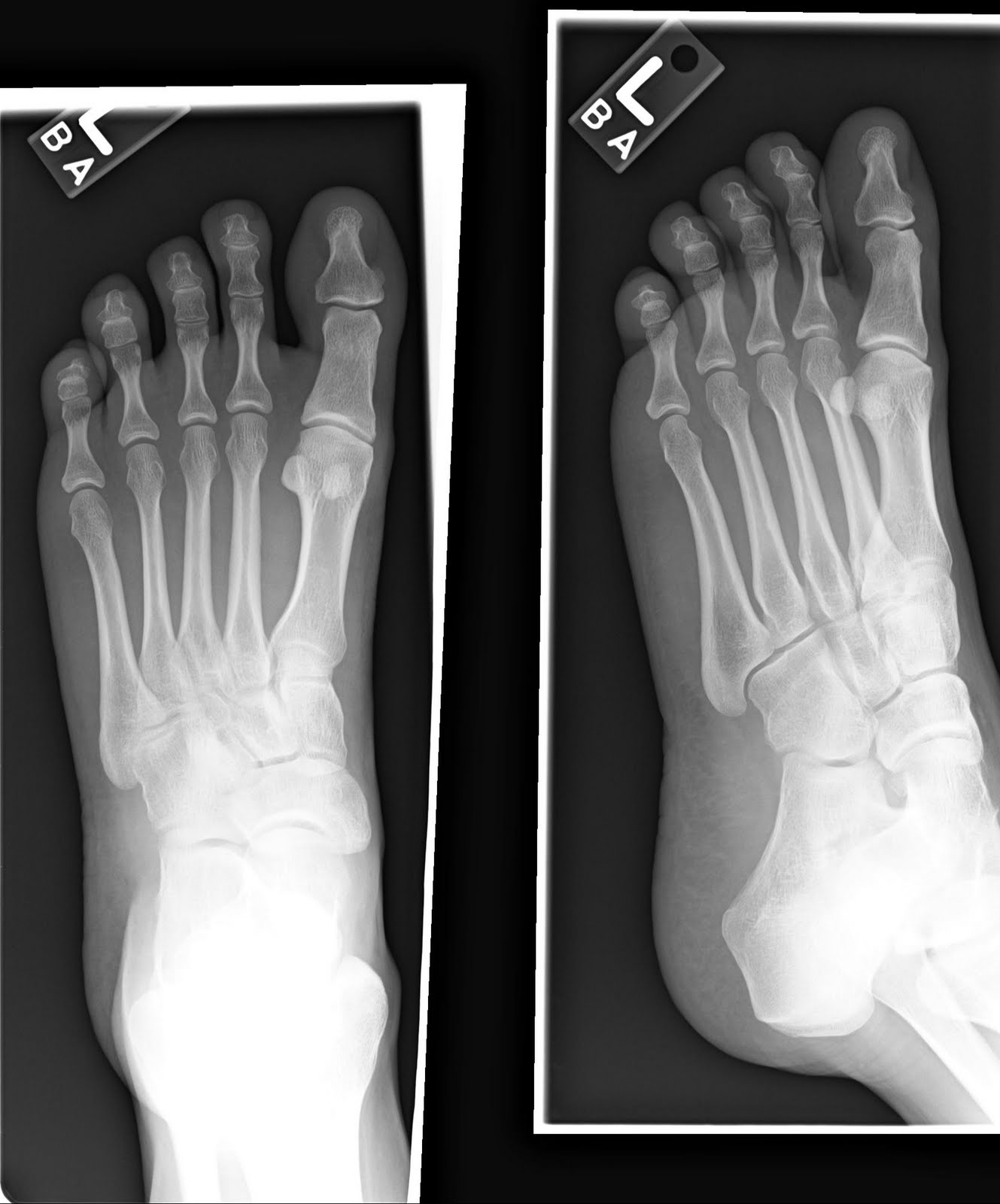 Right Foot X Ray